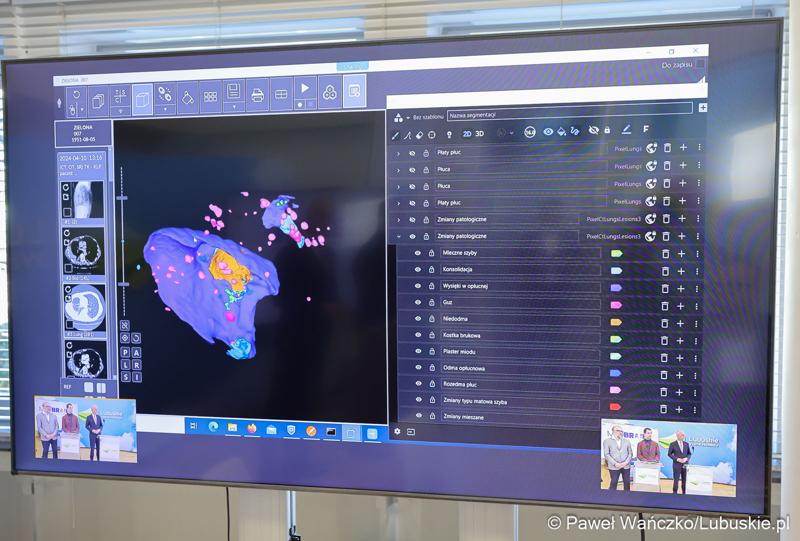 Monitor z prezentacją podczas konferencji prasowej dot. lubuskiego projektu wsparcia diagnostyki i medycyny systemami Sztucznej Inteligencji - MedBrain L